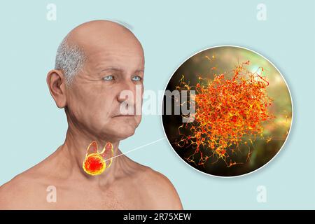 Cancro della ghiandola tiroidea con vista di closeup delle cellule tumorali, illustrazione del computer. Foto Stock