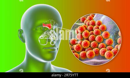 Sinusite batterica, illustrazione del computer. I seni sono spazi riempiti d'aria con membrana nelle ossa del viso. I seni frontali sono superiori a t. Foto Stock