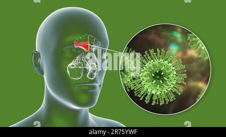 Sinusite virale, illustrazione del calcolatore. I seni sono spazi riempiti d'aria con membrana nelle ossa del viso. I seni frontali si trovano sopra la e Foto Stock