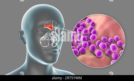 Sinusite batterica, illustrazione del computer. I seni sono spazi riempiti d'aria con membrana nelle ossa del viso. I seni frontali sono superiori a t. Foto Stock