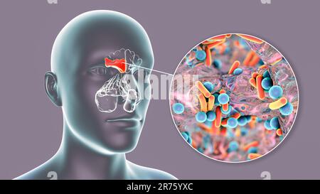 Sinusite batterica, illustrazione del computer. I seni sono spazi riempiti d'aria con membrana nelle ossa del viso. I seni frontali sono superiori a t. Foto Stock