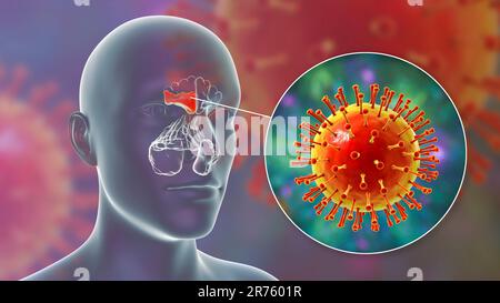 Sinusite virale, illustrazione del calcolatore. I seni sono spazi riempiti d'aria con membrana nelle ossa del viso. I seni frontali si trovano sopra la e Foto Stock
