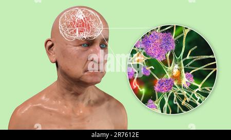 Morbo di Alzheimer, illustrazione concettuale del computer che mostra una persona anziana con disabilità progressive delle funzioni cerebrali, placche amiloidi in br Foto Stock