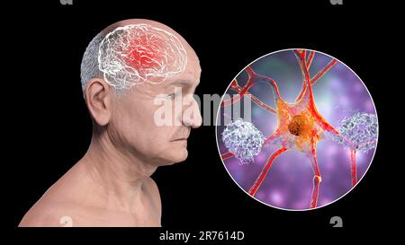 Morbo di Alzheimer, illustrazione concettuale del computer che mostra una persona anziana con disabilità progressive delle funzioni cerebrali, placche amiloidi in br Foto Stock