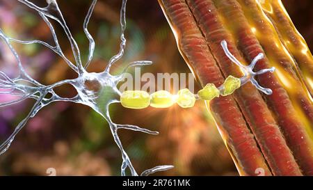 Demielinizzazione del neurone, il danno della guaina di mielina del neurone visto in malattie demielinizzanti, come la sclerosi multipla e altri miti demielinizzanti Foto Stock