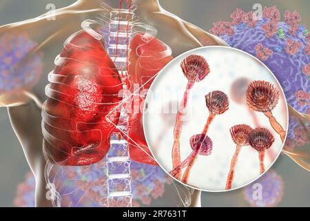 Aspergillosi polmonare, invasione di un tessuto polmonare da funghi muffa Aspergillus con vista ravvicinata dei funghi, computer illustrazione. Foto Stock
