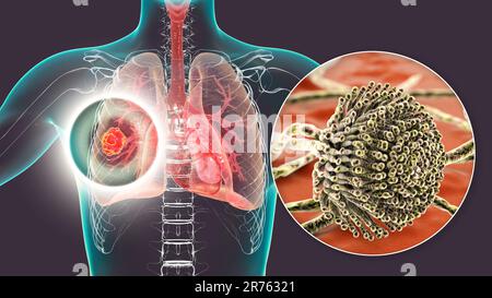 Aspergillosi polmonare, invasione di un tessuto polmonare da funghi muffa Aspergillus con vista ravvicinata dei funghi, computer illustrazione. Foto Stock