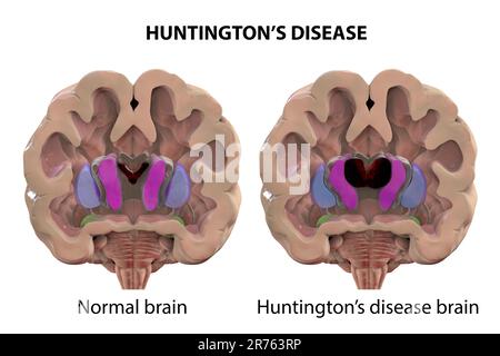 Striato dorsale e ventricoli laterali nel cervello sano e nel morbo di Huntington (HD). Illustrazione del computer che mostra l'ingrandimento dell'ho anteriore Foto Stock