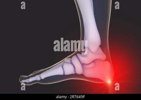 Dolore al piede e alla caviglia, illustrazione del computer. Sperone del tallone. Foto Stock