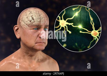 Demenza e morbo di Alzheimer, illustrazione concettuale del computer. Perdita di memoria, invecchiamento cerebrale, compromissione progressiva delle funzioni cerebrali in età anziana Foto Stock