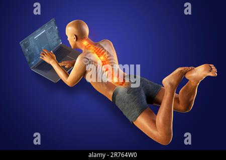 Lavorare con il computer portatile in una posizione errata. Concetto di mal di schiena. Illustrazione del computer che mostra il corpo maschio con lo scheletro evidenziato che funziona in un po sbagliato Foto Stock