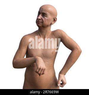 Una persona con la Corea di Huntington, una malattia neurodegenerativa dovuta a mutazione nel gene HTT, cambiamenti nei gangli basali cerebrali che portano a uncon casuale Foto Stock