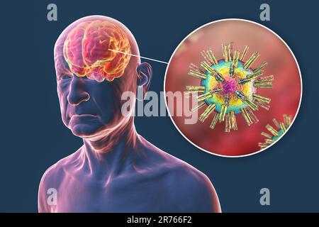 Eziologia infettiva della demenza. Illustrazione concettuale del computer che mostra una persona anziana con malattia di Alzheimer, menomazioni progressive del cervello Foto Stock