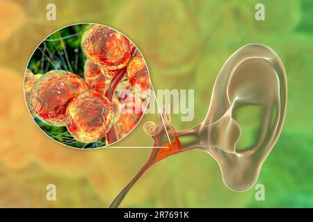 Otite fungina cronica media infezione dell'orecchio. Illustrazione del computer che mostra l'infiammazione dell'orecchio medio e vista ravvicinata dei funghi Candida albicans, t Foto Stock