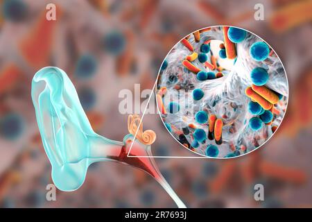 Otite media infezione dell'orecchio e vista closeup dei batteri, gli agenti eziologici dell'infiammazione dell'orecchio medio, illustrazione concettuale del calcolatore. Acut Foto Stock