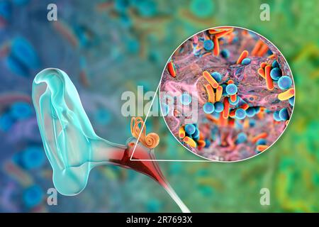 Otite media infezione dell'orecchio e vista closeup dei batteri, gli agenti eziologici dell'infiammazione dell'orecchio medio, illustrazione concettuale del calcolatore. Acut Foto Stock