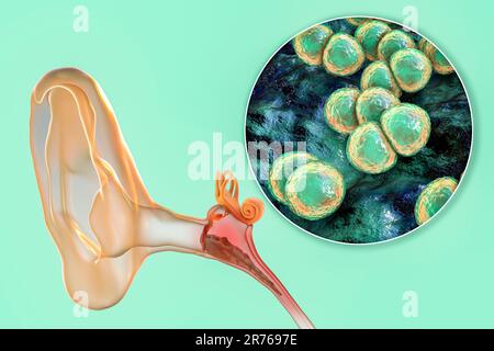Otite media infezione dell'orecchio causata da batteri Streptococcus pneumoniae, illustrazione concettuale del computer. L'otite media acuta è l'infiammazione della Th Foto Stock
