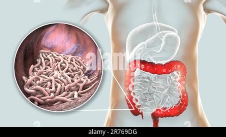 Vermi rotondi in intestino crasso umano, computer artwork. I vermi rotonde, o nematodi, comprendono numerose specie di vita libera e patogeniche. Pinworm (Entero Foto Stock