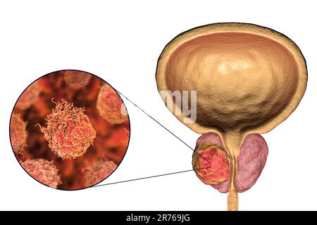 Cancro della prostata. Illustrazione computerizzata di un tumore canceroso nella ghiandola prostatica (destra) e vista ravvicinata delle cellule del cancro prostatico (sinistra). L'uretra c Foto Stock