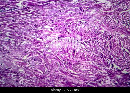 Fibroide uterino. Micrografia di luce (LM) di una sezione attraverso il tessuto dall'utero, in un caso di fibroidi uterini (leiomiomi). Un fibroma è un benigni Foto Stock