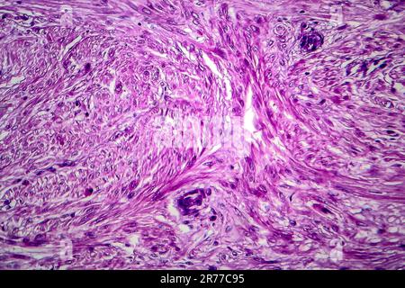 Fibroide uterino. Micrografia di luce (LM) di una sezione attraverso il tessuto dall'utero, in un caso di fibroidi uterini (leiomiomi). Un fibroma è un benigni Foto Stock