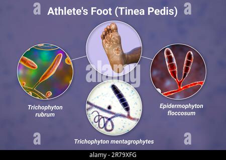 Il piede di una persona dalla pelle scura con micosi, e vista ravvicinata dei funghi Epidermohyton floccosum, Trichophyton mentagrophytes e T. rubrum che ca Foto Stock