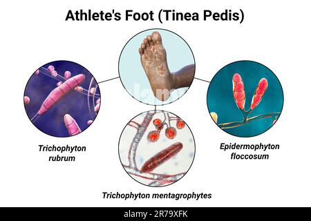 Il piede di una persona dalla pelle scura con micosi, e vista ravvicinata dei funghi Epidermohyton floccosum, Trichophyton mentagrophytes e T. rubrum che ca Foto Stock