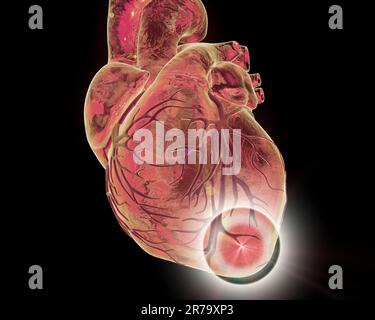 Attacco di cuore, immagine concettuale per le malattie cardiache. Illustrazione 3D Foto Stock