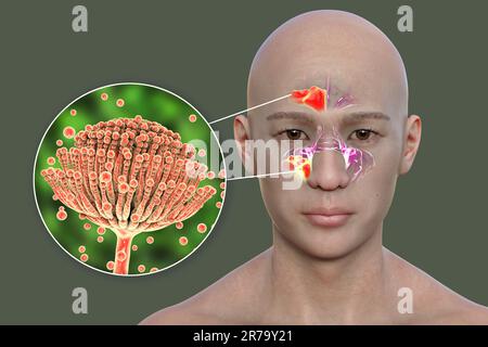 Funghi Aspergillus come causa di sinusite. 3D illustrazione che mostra infiammazione dei seni mascellari in una vista dell'uomo e primo piano del fungo di Aspergillus. Foto Stock