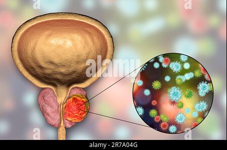 Immagine concettuale per ethiology virale del cancro della prostata. 3D illustrazione che mostra i virus di infettare ghiandola della prostata che sviluppa il tumore canceroso Foto Stock