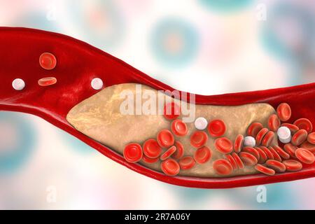 Placca di colesterolo in arteria, 3D'illustrazione. Concetto di malattia coronarica Foto Stock