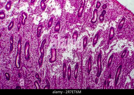 Iperplasia endometriale. Micrografia di luce di una sezione attraverso il tessuto dall'endometrio, in un caso di iperplasia endometriale. L'endometrio è t Foto Stock