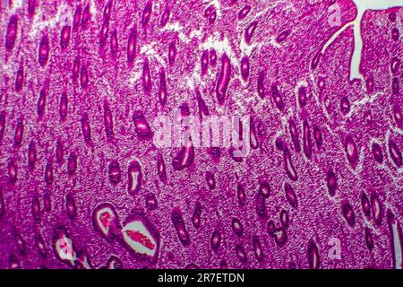 Iperplasia endometriale. Micrografia di luce di una sezione attraverso il tessuto dall'endometrio, in un caso di iperplasia endometriale. L'endometrio è t Foto Stock