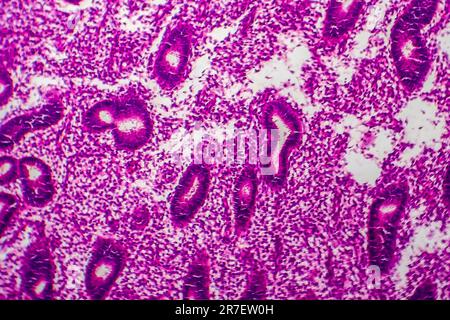 Iperplasia endometriale. Micrografia di luce di una sezione attraverso il tessuto dall'endometrio, in un caso di iperplasia endometriale. L'endometrio è t Foto Stock