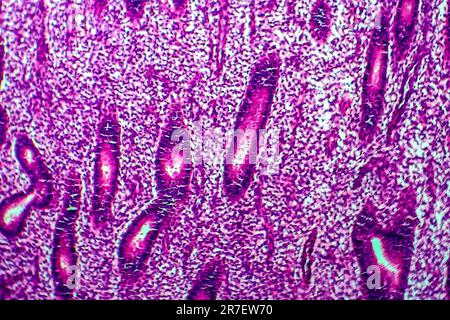 Iperplasia endometriale. Micrografia di luce di una sezione attraverso il tessuto dall'endometrio, in un caso di iperplasia endometriale. L'endometrio è t Foto Stock