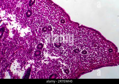 Iperplasia endometriale. Micrografia di luce di una sezione attraverso il tessuto dall'endometrio, in un caso di iperplasia endometriale. L'endometrio è t Foto Stock