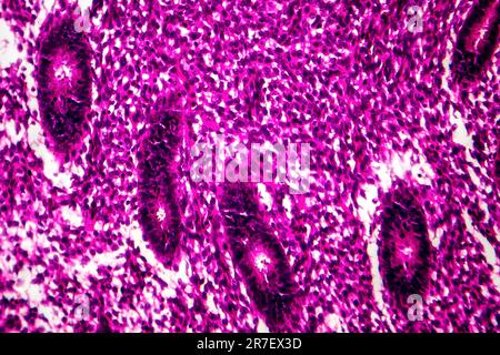 Iperplasia endometriale. Micrografia di luce di una sezione attraverso il tessuto dall'endometrio, in un caso di iperplasia endometriale. L'endometrio è t Foto Stock