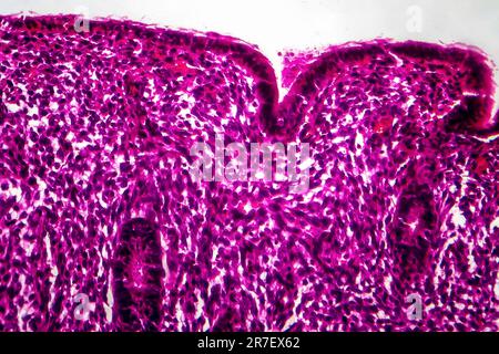 Iperplasia endometriale. Micrografia di luce di una sezione attraverso il tessuto dall'endometrio, in un caso di iperplasia endometriale. L'endometrio è t Foto Stock