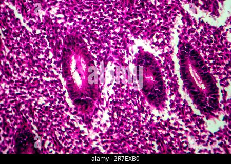 Iperplasia endometriale. Micrografia di luce di una sezione attraverso il tessuto dall'endometrio, in un caso di iperplasia endometriale. L'endometrio è t Foto Stock