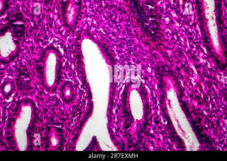 Iperplasia endometriale. Micrografia di luce di una sezione attraverso il tessuto dall'endometrio, in un caso di iperplasia endometriale. L'endometrio è t Foto Stock