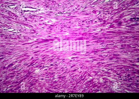 Fibroide uterino. Micrografia di luce (LM) di una sezione attraverso il tessuto dall'utero, in un caso di fibroidi uterini (leiomiomi). Un fibroma è un benigni Foto Stock