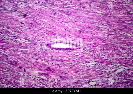 Fibroide uterino. Micrografia di luce (LM) di una sezione attraverso il tessuto dall'utero, in un caso di fibroidi uterini (leiomiomi). Un fibroma è un benigni Foto Stock