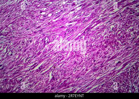 Fibroide uterino. Micrografia di luce (LM) di una sezione attraverso il tessuto dall'utero, in un caso di fibroidi uterini (leiomiomi). Un fibroma è un benigni Foto Stock