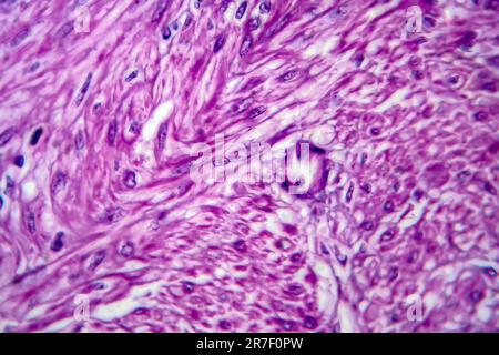 Fibroide uterino. Micrografia di luce (LM) di una sezione attraverso il tessuto dall'utero, in un caso di fibroidi uterini (leiomiomi). Un fibroma è un benigni Foto Stock