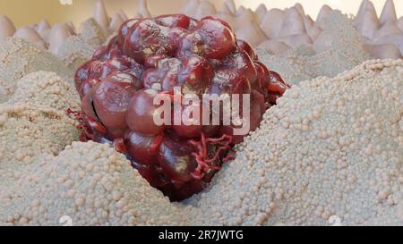 Crescita delle cellule tumorali incontrollabile sui tessuti, cellule di infezione tumorale e diffusione, metastasi infiammatoria invasiva cancerosa. riproduzione tramite duplicati Foto Stock