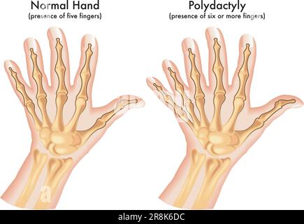 Illustrazione medica di una mano afflitta da polidattile, un'anomalia congenita caratterizzata dalla presenza di sei o più dita. Illustrazione Vettoriale