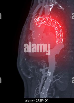 CTA intera aorta con innesto di stent dell'aorta toracica immagine di rendering 3D in caso di aneurismi aortici addominali. Foto Stock