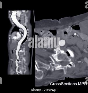 CTA curva MPR aorta intera. Foto Stock