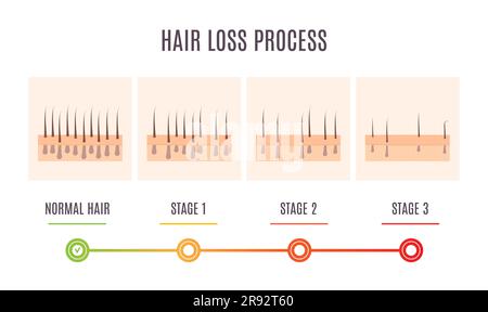 Processo di perdita dei capelli, illustrazione concettuale Foto Stock