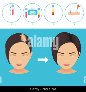 Trattamento per la perdita dei capelli PRP, illustrazione Foto Stock